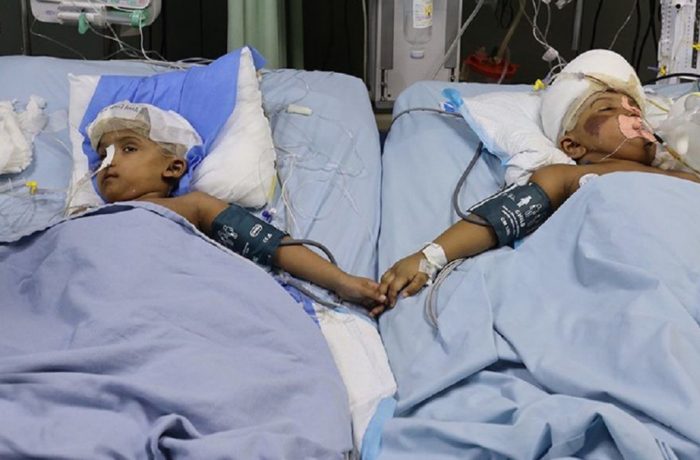 Szétválasztott sziámi ikrek - Rabeyán sürgős műtétet kellett végezni
